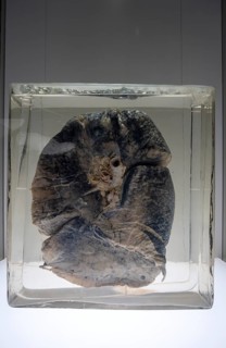 Dust lung of a miner
