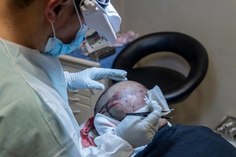 Hair transplant. Surgeons in the operating room carry out hair transplant surgery