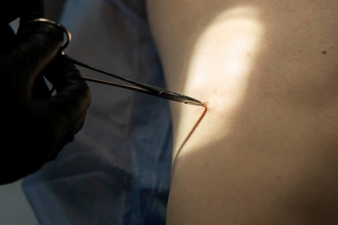Doctor performing surgery for mole removal