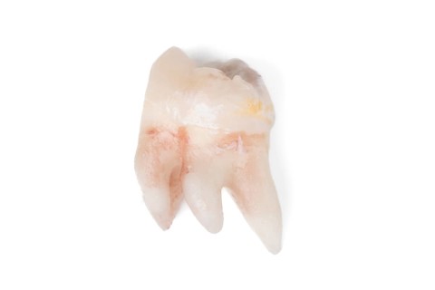 Pulled wisdom tooth