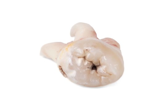 Pulled wisdom tooth