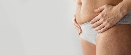 Close up body with stretch marks copy space