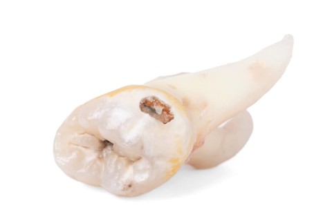 Pulled wisdom tooth