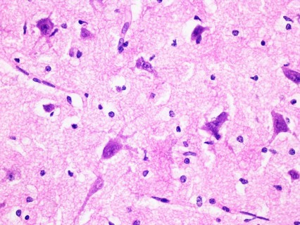 Histology of Human Brain Tissue Viewed at 400x Magnification with Haemotoxylin and Eosin Staining
