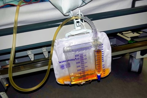 Bladder catheter applied