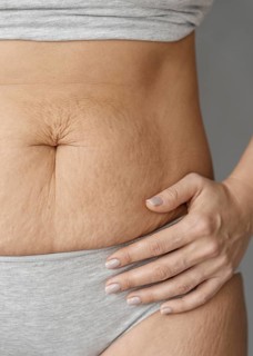 Close up body with stretch marks