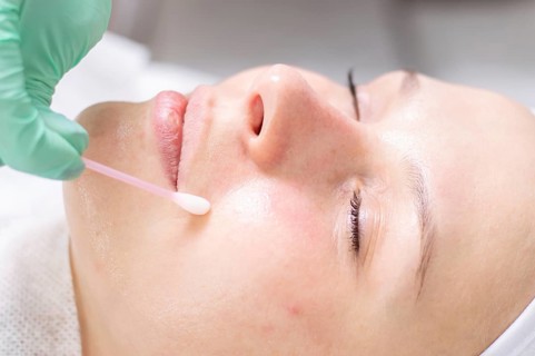 Portrait of a woman's face with problem skin. Peeling procedure. Natural beauty.