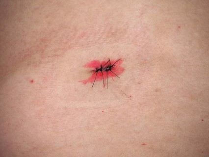 Surgical wound with stitches and iodine tincture