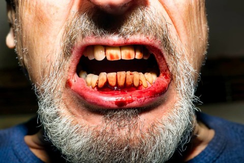 Symbol photo for aggression, Dracula, violence, brawl, injury and tantrum, an elderly man with a