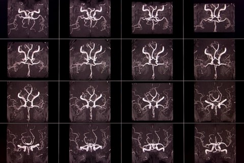 Black and white MRI images of a human brain showing the arteries in different layers, organised in