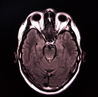 Black and white image of an MRI scan of a brain, showing detailed brain structure