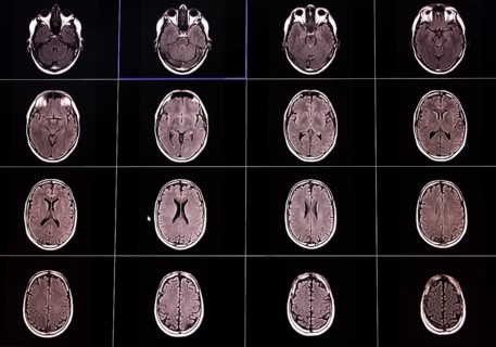 Several MRI scans of brain cross-sections shown in black and white on a black background