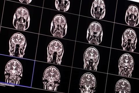 Several MRI images of a human brain in black and white, arranged in a grid view