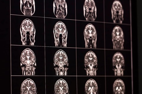 MRI scans of a brain in black and white, organised in a matrix, show different sections
