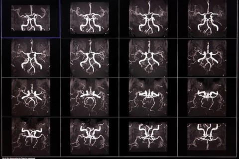 Several MRI images show the arteries of the brain in black and white with detailed neuronal