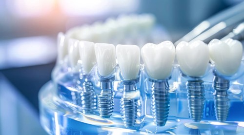 A close up of a titanium modern dental implant teeth with a silver implant screw, AI generated