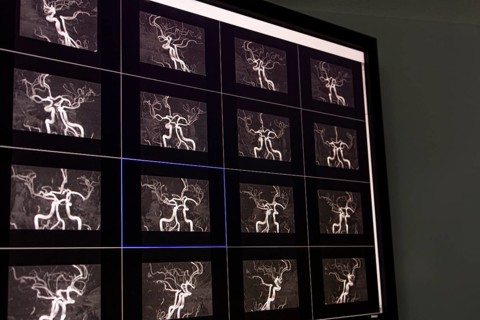 Several magnetic resonance imaging MRI cross-sectional images of the cerebral arteries and vessels
