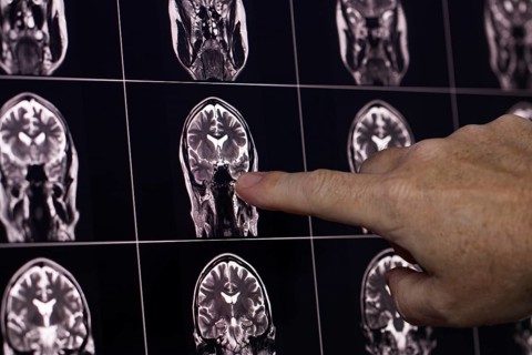 Finger points to a section of a brain MRI image