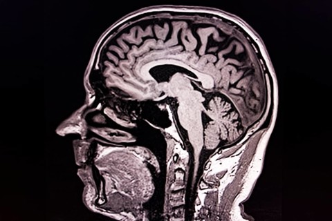Lateral black and white MRI scan of a human brain and skull