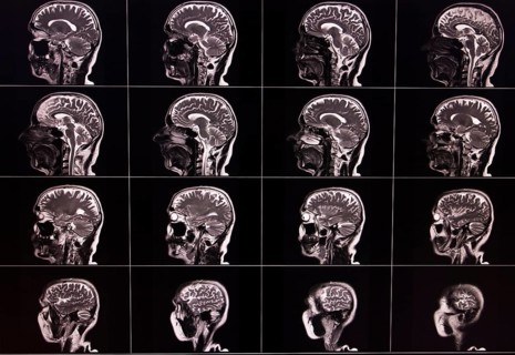 Several lateral MRI images of a brain showing different layers and details
