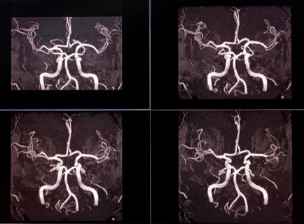 MRI X-ray image of brain arteries showing complex blood vessels in black and white