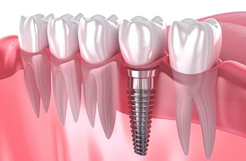 A close up of a titanium modern dental implant teeth with a silver implant screw, AI generated