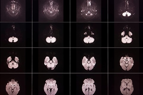 Several black and white MRI scans of a brain in different layers and angles, organised in a matrix