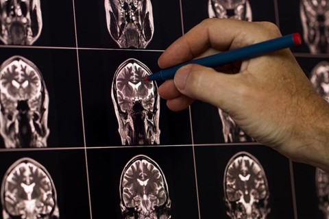 Hand with pen points to MRI images of human brains in black and white