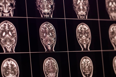 Several human MRI brain scans arranged in black and white on a panel