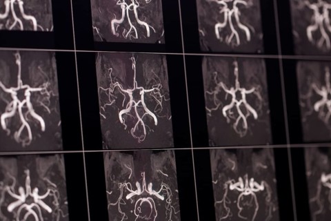 X-ray images of cerebral arteries and vessels of a human head, shown in black and white contrasts