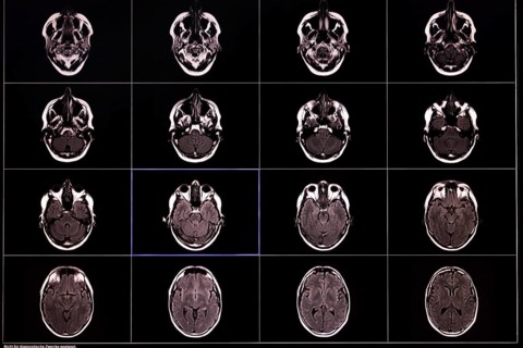 Black and white images of an MRI scan of the brain in several sectional planes