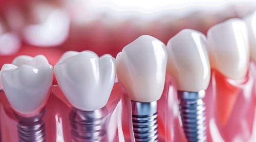 A close up of a titanium modern dental implant teeth with a silver implant screw, AI generated