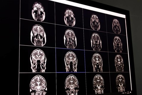 Black and white image of an MRI scan of the brain displayed on a screen