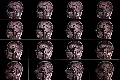 Several lateral MRI images of a brain, displayed in a matrix, show different layers