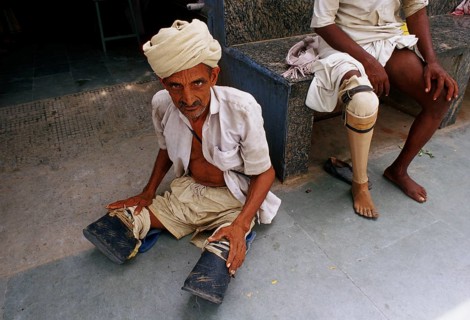Double leg amputee waiting for a prosthesis called Jaipur foot (or leg), leg amputee with a Jaipur