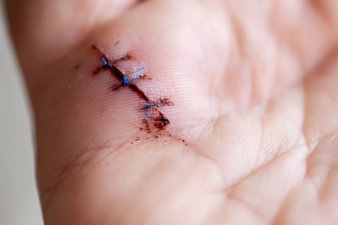 Operated snap finger, wound closed with three stitches, snap finger is the result of tendinitis of