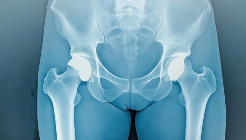 X-ray image of hips with implants in the pelvic region, AI generated, AI generated