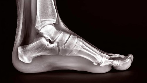 Side view of a foot, shown in an X-ray image with clearly recognisable bone structures, AI