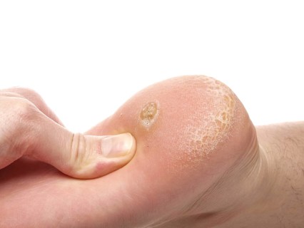 Dermatologist examining a foot for callus and dry skin, towards white
