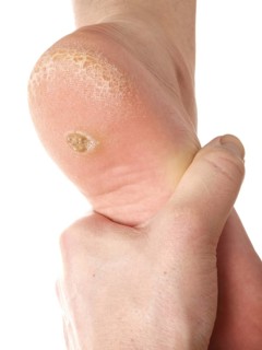 Dermatologist examining a foot for callus and dry skin, towards white