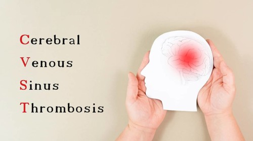 Cerebral venous sinus thrombosis is standing on the background, Silhouette of a head with a brain,