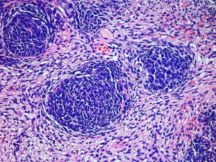 Microscopic Image of a Wilms Tumor or Nephroblastoma of a childs kidney viewed at 200x