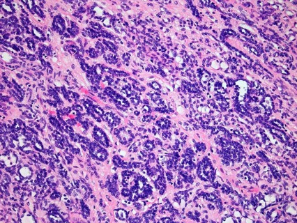 Wilms Tumor or Nephroblastoma of a childs kidney viewed at 200x magnification with hematoxylin and