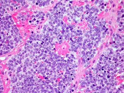 Microscopic image of a Neuroblastoma malignant tumor of the adrenal gland viewed at 300x