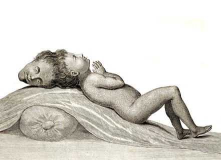 A child with two heads joined at the apex, Siamese twins, Double malformation, a maldevelopment in