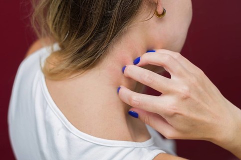 Great concept of allergy and skin diseases, young woman scratching herself