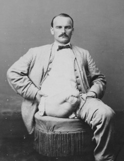War-wounded Private Charles Myer, amputation of the right thigh, from the Photographic Catalogue of