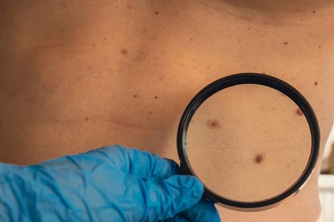 Unrecognizable Dermatologist examining patient's birthmark with magnifying glass in clinic. Mole