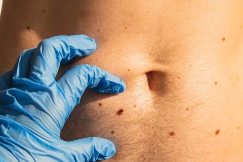 Dermatologist checking male birthmarks. Doctor in medical gloves examining man skin mole. Self care