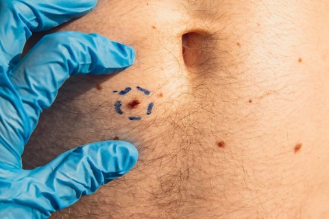 Doctor in medical gloves paint lines around male birthmarks. Preparing procedure for medical